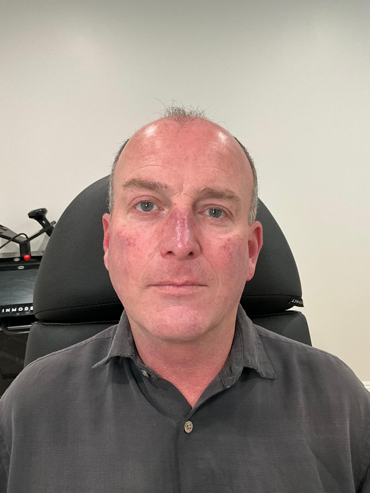 Before treatment